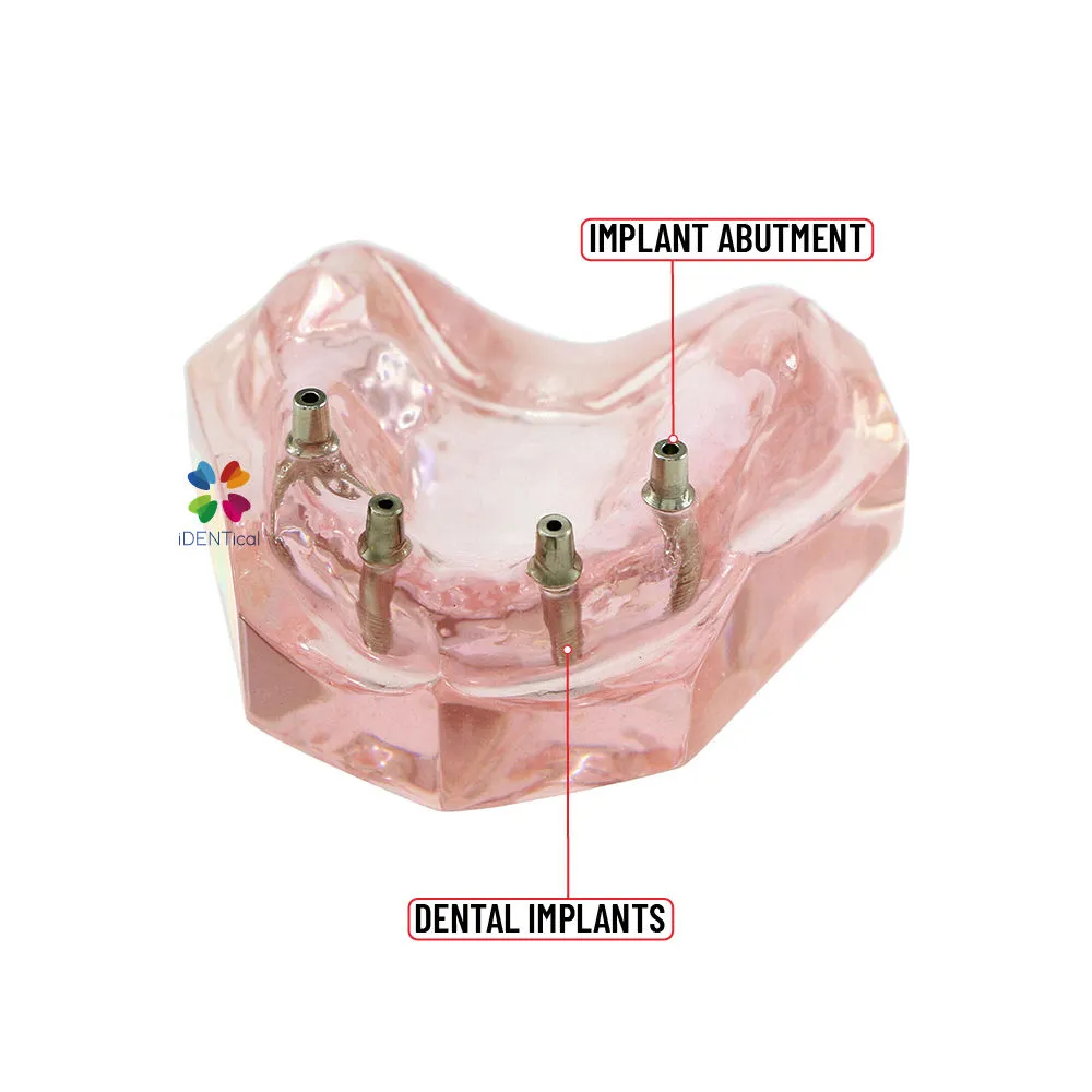 iDENTical Dental Model for Overdenture Maxilla M6001 iDENTical Dental Model for Overdenture Maxilla M6001