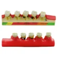 iDENTical Dental Model-Stages of Periodontitis M4010