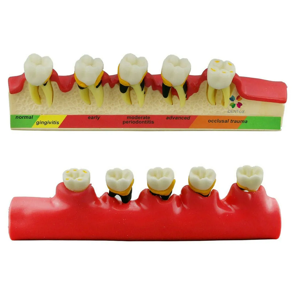 iDENTical Dental Model-Stages of Periodontitis M4010
