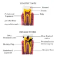 caries-vs-healthy-teeth-mode-3_1_
