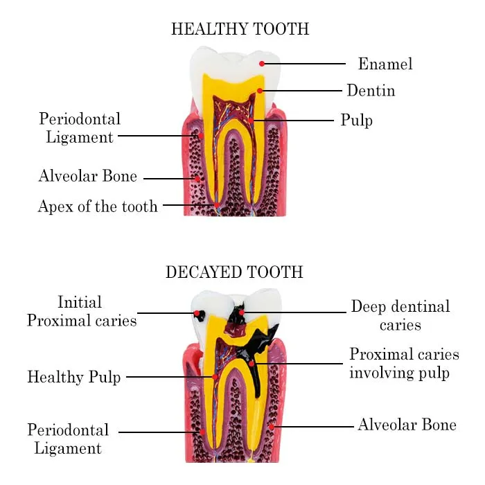 caries-vs-healthy-teeth-mode-3_1_ caries-vs-healthy-teeth-mode-3_1_