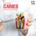 iDENTical Caries V/S Healthy Teeth Model M4021