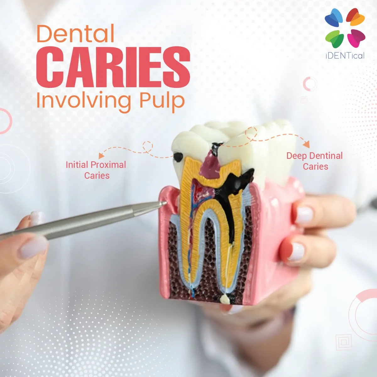 iDENTical Caries V/S Healthy Teeth Model M4021 iDENTical Caries V/S Healthy Teeth Model M4021