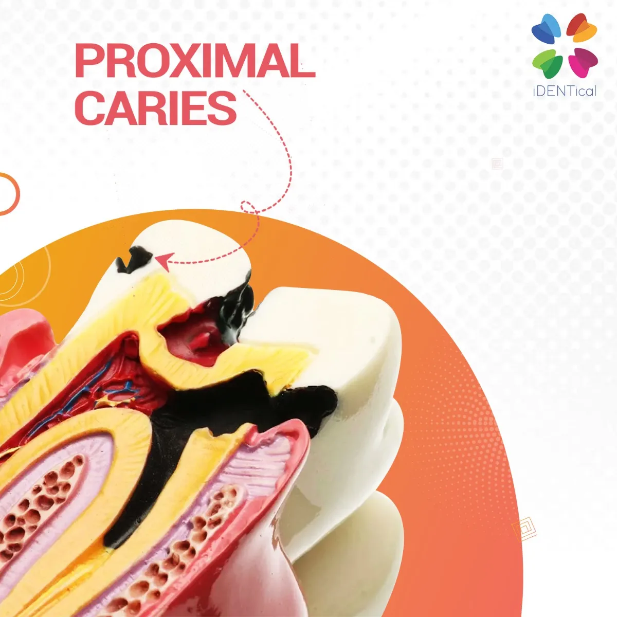 caries_vs_healthy_teeth-6 caries_vs_healthy_teeth-6