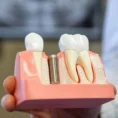 dental-implant-model
