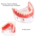 dental-lower-inferior-teeth-model-overdenture-4-implants