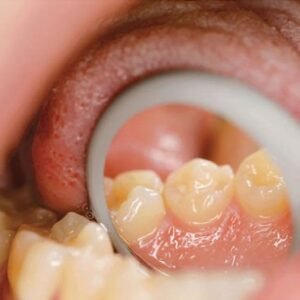 Roder HR Front Double Sided Mouth Mirror