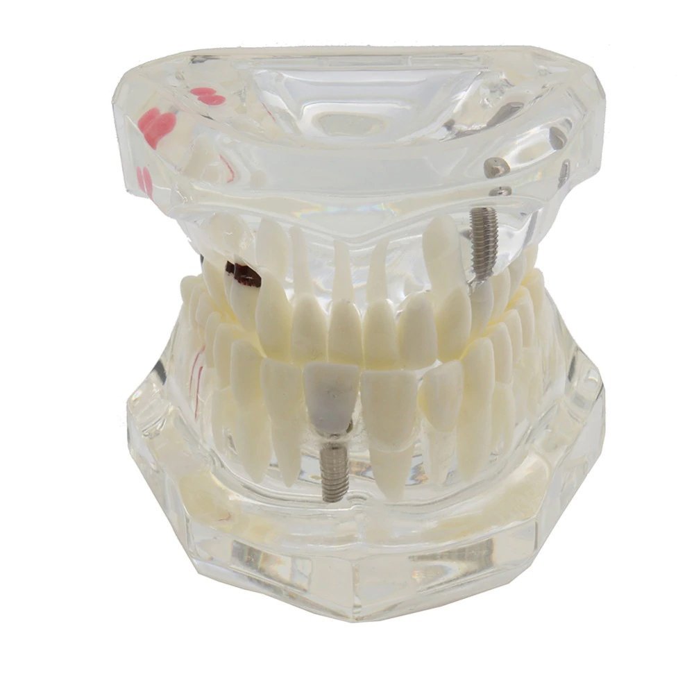 Dental Study Model With Pathology And Half Implant