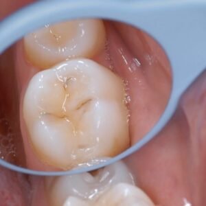 Hahnenkratt Relax Fs Rhodium Mouth Mirror #5 Set