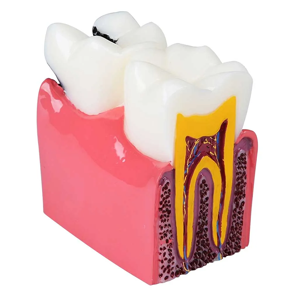 identical-caries-healthy-teeth-model-m4021-b identical-caries-healthy-teeth-model-m4021-b