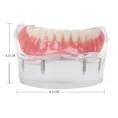 identical-mandibular-overdenture-model-with-4-implants-m6003