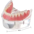 identical-mandibular-overdenture-model-with-4-implants-m6003-b