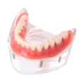 new-dental-tooths-model-overdenture-inferior-with-4-_57.jpg1