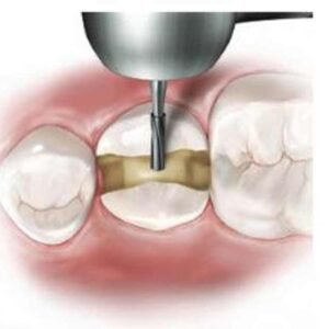 Ss White Surgical Length Carbide Fg Burs